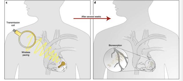 可被身体吸收，无需电池的心脏起搏器问世